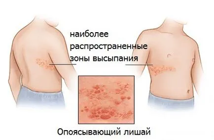 Hogyan kell kezelni a herpes zoster Body