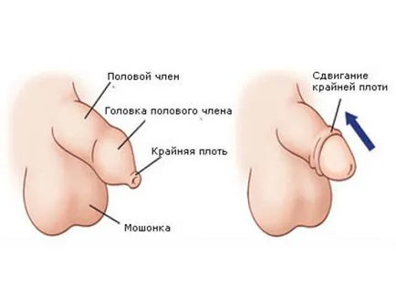 Как за лечение на фимоза лазери мъже, мазила и използване дисекция на препуциума