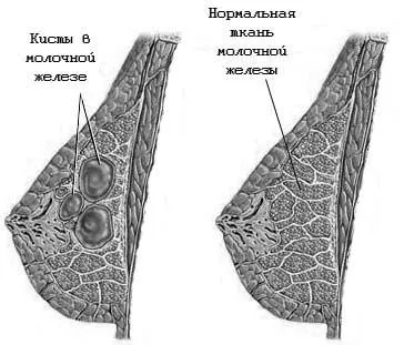 Как за лечение на кистозна фибро мастопатия