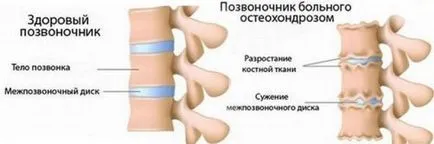 Cum de a dormi cu osteochondrosis de col uterin, pe o perna pentru a dormi mai bine