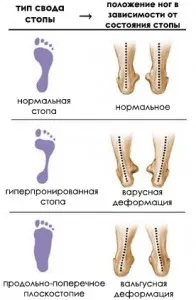 Плоски крака при възрастни и нейното лечение