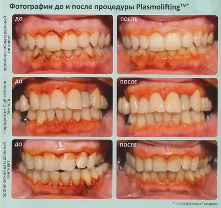 Plazmolifting gumik azaz valódi fogászat a kijevi Moszkva