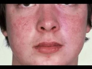 Milyen tünetei vannak az allergiás dermatitis felnőtteknél