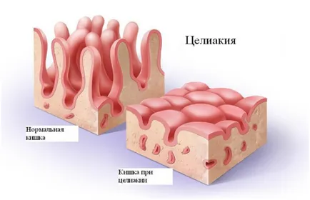 Как сте алергични към глутен в симптомите на детето и grudnichka и снимки