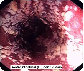 nyelőcső-candidiasis vagy candida oesophagitis