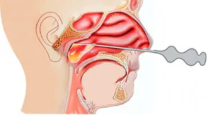 Cyst sinus kezelési és eltávolítási