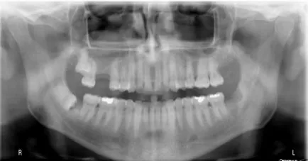 Chist sinus maxilar și Removal endoscopice (operare) Simptome si tratament