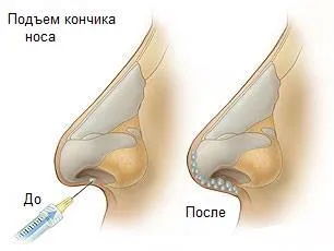 Контурна пластика на носа какво е, видове, показания и противопоказания