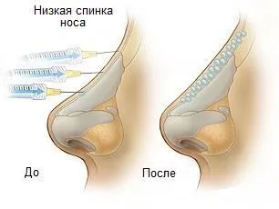 Контурна пластика на носа какво е, видове, показания и противопоказания