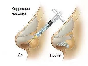 Контурна пластика на носа какво е, видове, показания и противопоказания