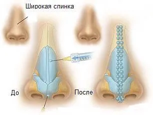 Контурна пластика на носа какво е, видове, показания и противопоказания