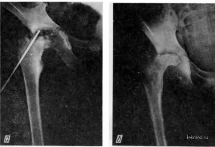 Tratamentul conservator al pacienților cu osteomielită cronică - tratamentul osteomielitei la copii