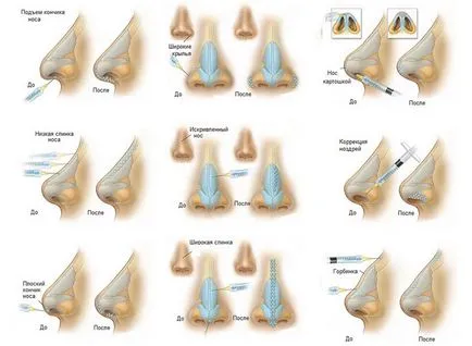 Procedurile Conturarea rinoplastie sunt, indicații, contraindicații, complicații, tipuri de second hand