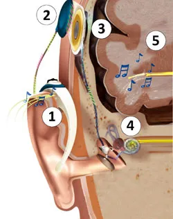 cochleáris implantátumok