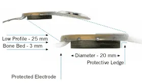 cochleáris implantátumok