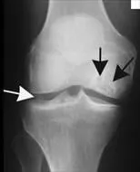 Лечение на аваскуларна некроза на колянната става, ортопедична травматология Новиков