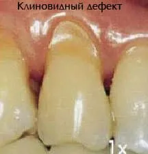 A periodontális betegségek kezelésében, a betegség képet