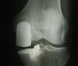 Tratamentul necroza avasculară a articulației genunchiului, traumatologist ortopedice Novikov