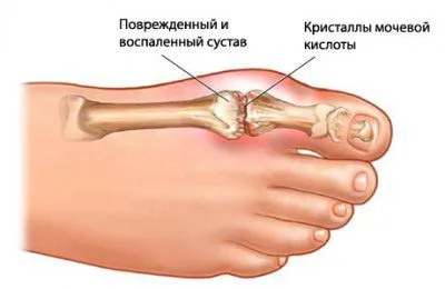 Лечение на подагра основни методи и тяхната ефективност