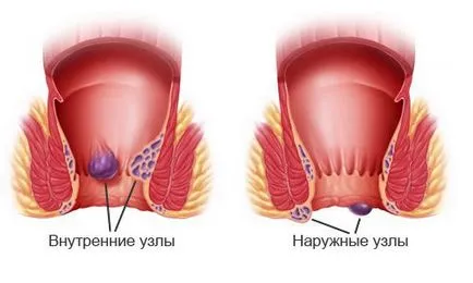 хемороиди лечение ефективни методи за борба с болест
