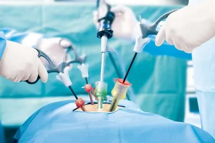 A laparoszkópos műtét részlege high-tech műtét urológián ők