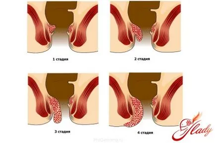 Лечение на хемороиди след раждането на народни средства