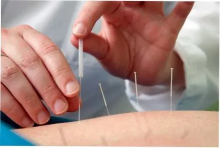 fibrom uterin tratament de acupunctura, acupunctura pentru fibrom uterin