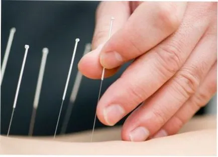 fibrom uterin tratament de acupunctura, acupunctura pentru fibrom uterin