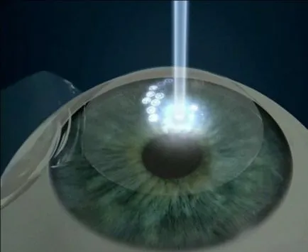 Лазерна хирургия, като начин за лечение на късогледство, за очно заболяване