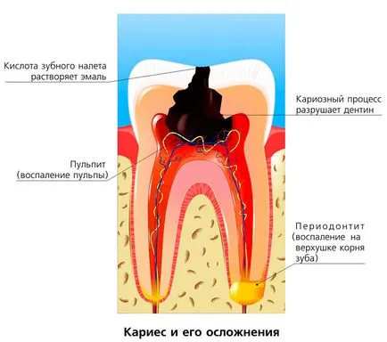 Tratamentul cariilor dentare la Harkov - este sigur, fara durere ghid de stomatologie