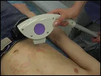 Лечение на кожни заболявания в Воронеж, Център за лечение на кожни заболявания Воронеж, при лечението на пърхот