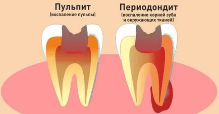 Лечение на пулпит първични зъби при деца в Екатеринбург цени, коментари и адреси