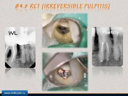 Tratamentul stomatologic cu canale complexe, perfectsmile