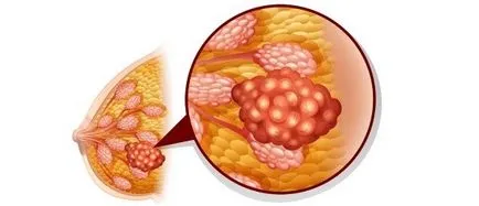 Mamografie sau ecografie de san san