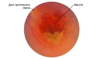 Módszerek a diagnózis és a kezelés a retina disztrófia