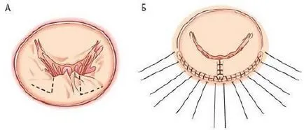 Metodele de tratament chirurgical al regurgitare mitrala