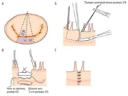 Metodele de tratament chirurgical al regurgitare mitrala