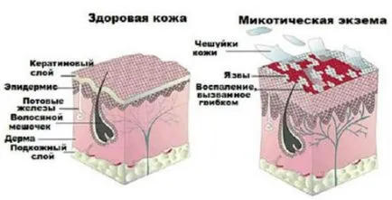 Микотични екзема на лакти и колене - методи на лечение