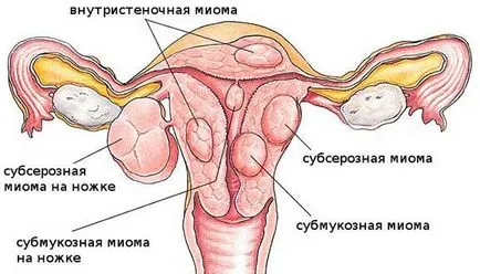 Миома на матката и полипи, симптоми и причини за заболяването