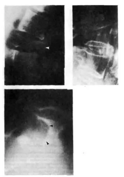 Myeloma kezelés és a tünetek, hogyan kell kezelni a myeloma (myeloma)