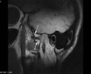 MRI a TMJ - temporomandibular állkapocs-ízületi, ízületi arc képalkotás, MRI TMJ ár