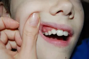 Creștere pe gingie - după îndepărtarea dintelui și a copilului atunci când erupția dinților (foto)