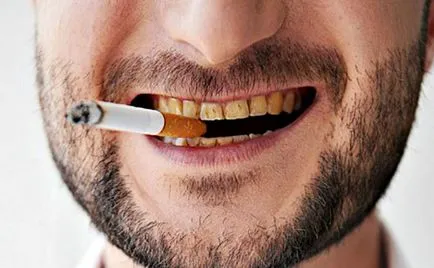 A plakk dohányos, hogyan lehet megszabadulni az okok, megelőzés, fotók