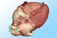 Tumorile inimii, tratamentul tumorilor cardiace în Israel