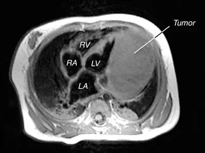 tumoare Heart (cancer, mixom, sarcom) tipuri, tratament