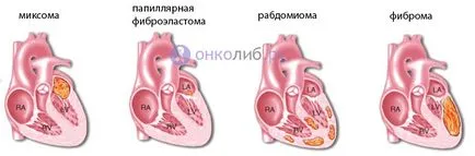 Heart тумор (рак, миксома, саркома) видове, лечението