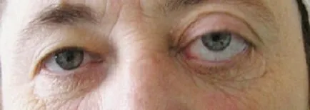 Daganatok a szemek - okai, tünetei és kezelése