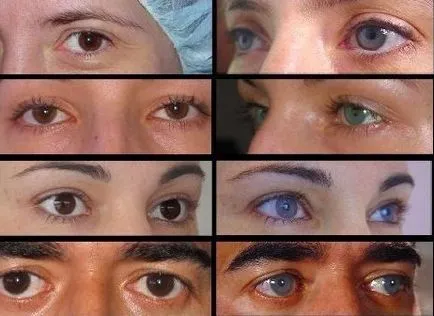 Операция цвят на очите, е възможно да се промени, ще помогне лазерната хирургия за промяна на цвят