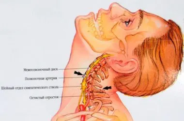 Osteochondrosis idegi tünetek és a kezelés