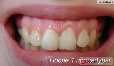 Albirea dintilor benzi dentare 360 ​​buyincoins dinti profesionale benzi de albire dinte